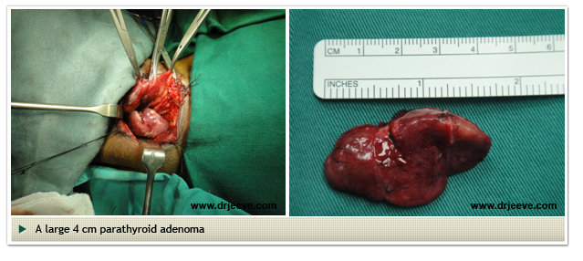 Parathyroid-surgery