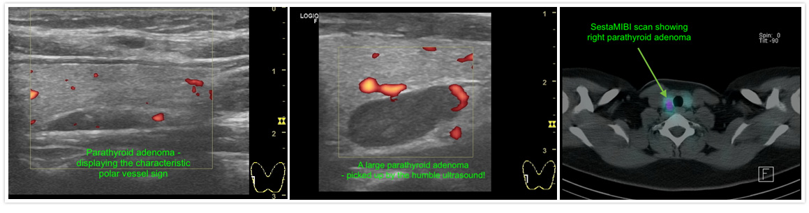 Parathyroid-surgery