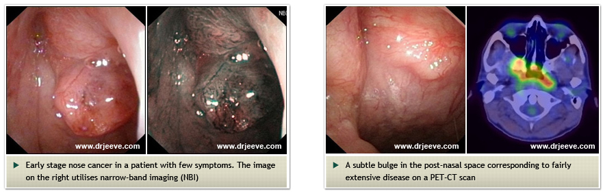 Head and Neck Cancers