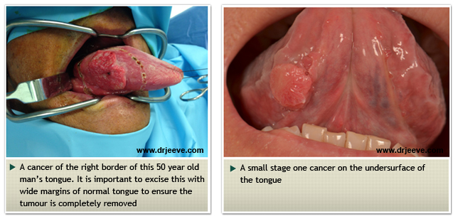 Head and Neck Cancers