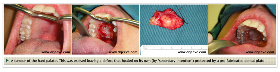 Head and Neck Cancers