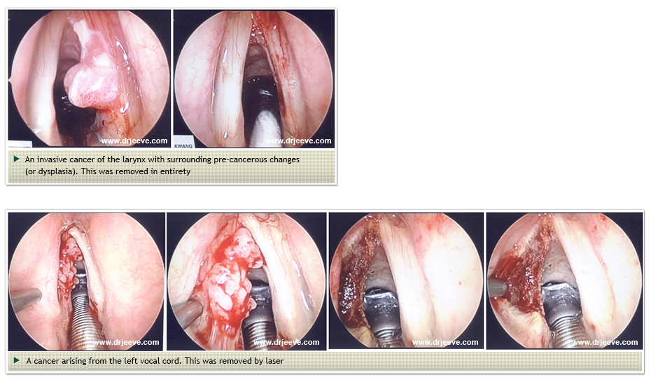 Head and Neck Cancers