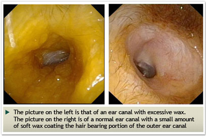 Parathyroid