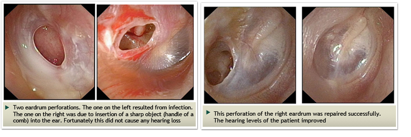 Parathyroid