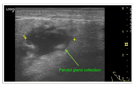 Salivary Gland