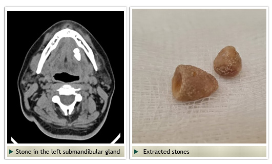 Salivary Gland