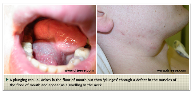 Dr Jeeve Ent Specialist In Singapore Salivary Gland Cancer