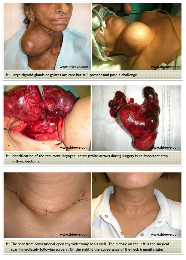 thyroid-surgery