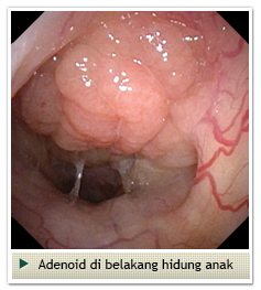 Apa itu adenoid