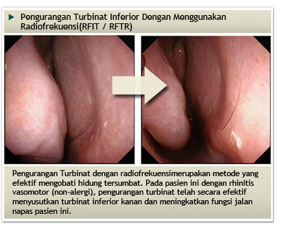 Allergy, Nose and Sinuses