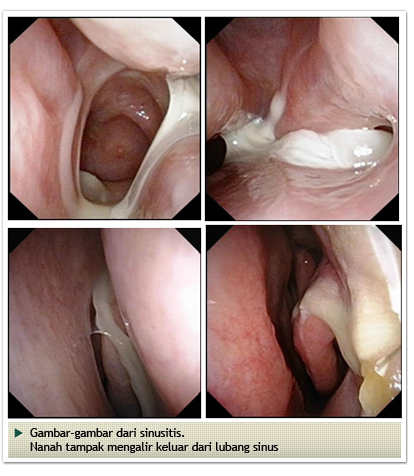 Allergy, Nose and Sinuses