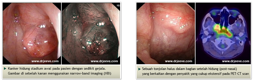 Head and Neck Cancers