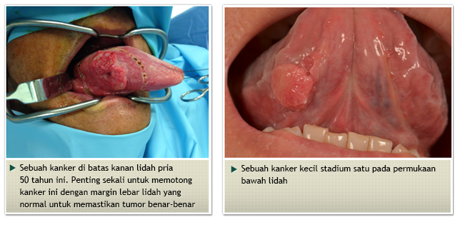 Head and Neck Cancers