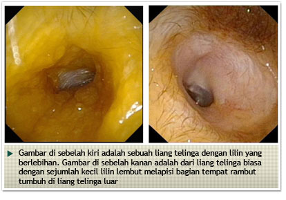 Parathyroid